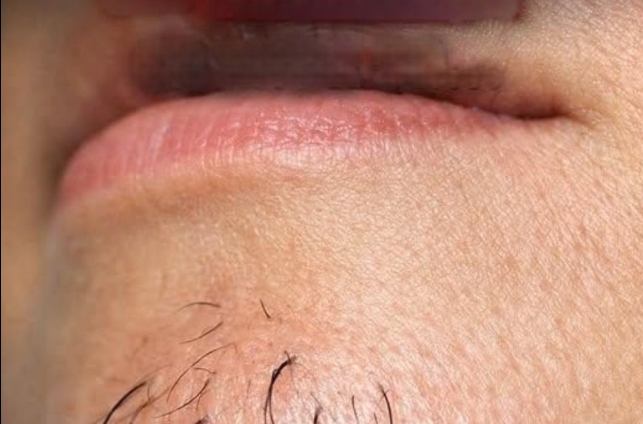 Beslenmenin Kadınlarda Çene Kıllarının Büyümesi