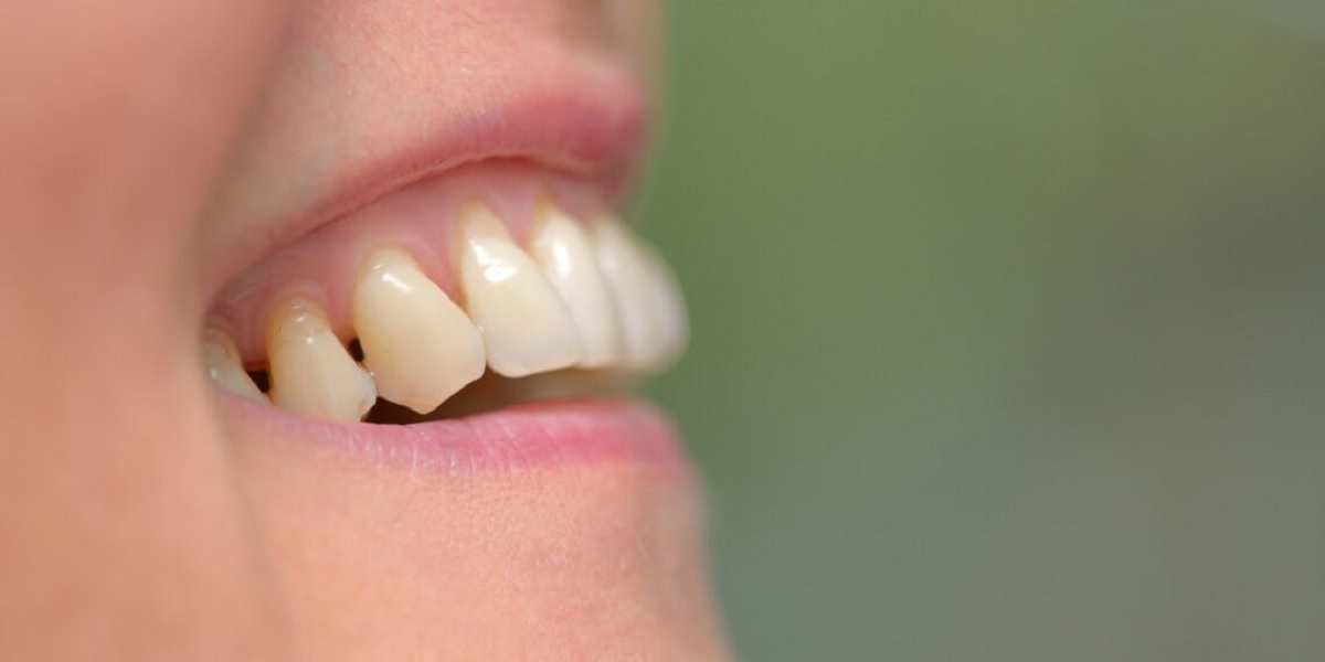 COVID-19: Şiddetli hastalık için olası bir risk faktörü olarak periodontal hastalık
