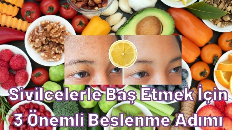 Sivilcelerle Baş Etmek İçin 3 Önemli Beslenme Adımı