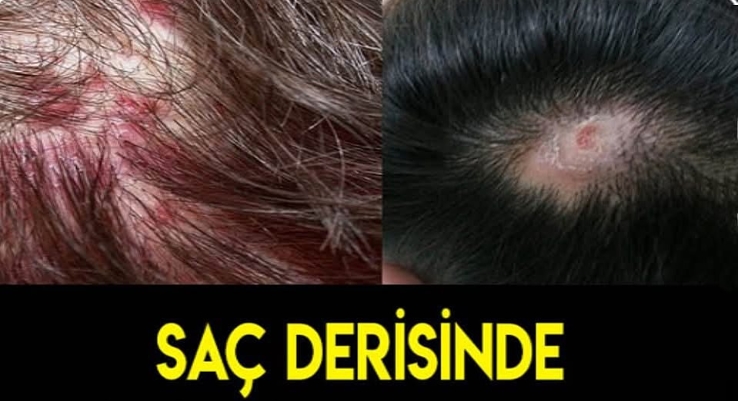 SAÇ DERİSİNDE KABUKLANMA VARSA DİKKAT