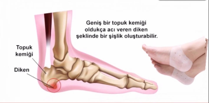 TOPUK DİKENİ NEDEN OLUR
