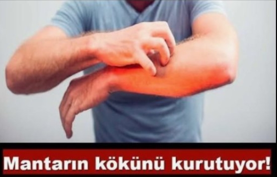 Nasır egzama ve mantara 5 dakikada çözüm
