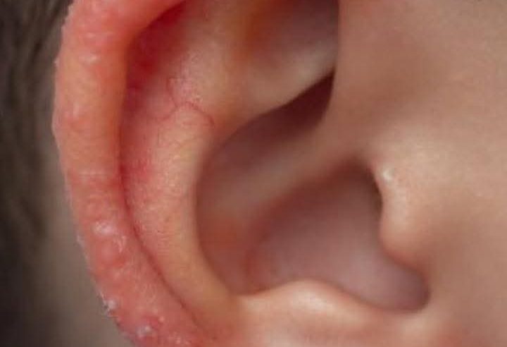 Bu sabah oğlum yanıma gelir gelmez kulağındaki garipliği fark ettim