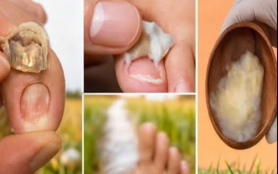 Tırnak mantarı ve aşırı terleme