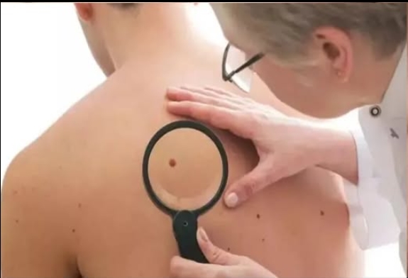 Kolon kanserinin en yaygın ve en kritik belirtileri