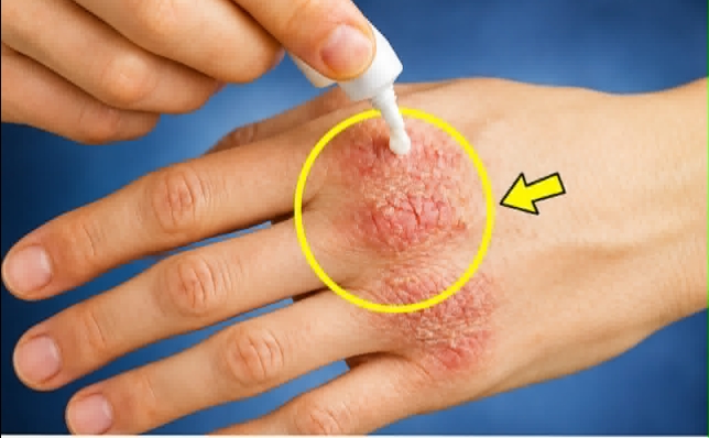 Doktorların tedavi edemediği egzamanın çaresini raflarda buldu